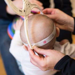 Measuring baby flat head syndrome severity with craniometer