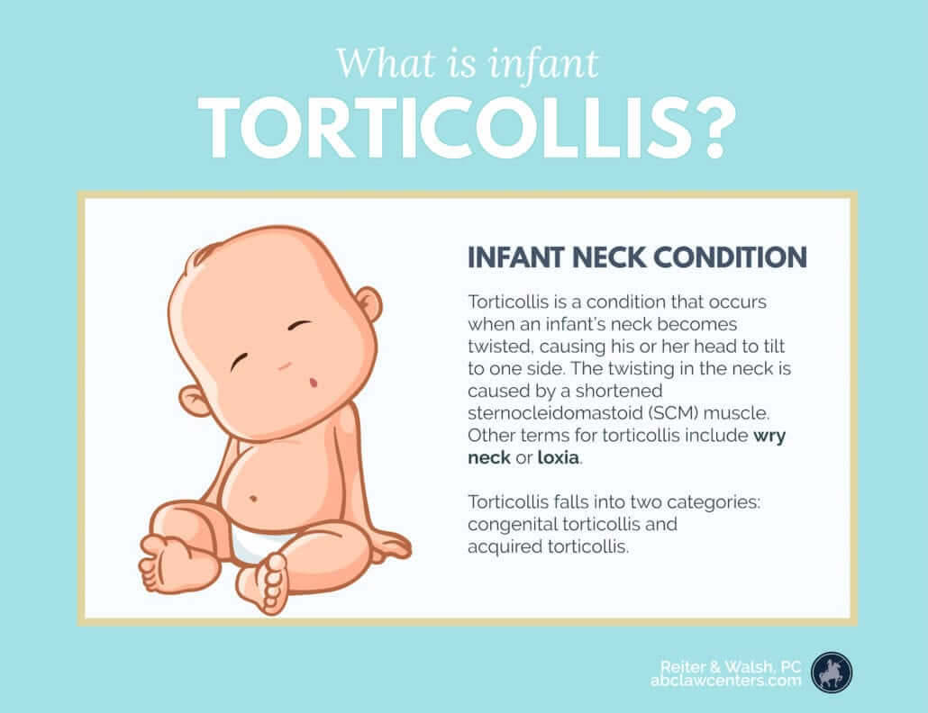 TOT-Collar Blog 3 ; What is infant Torticollis ?