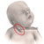 Torticollis