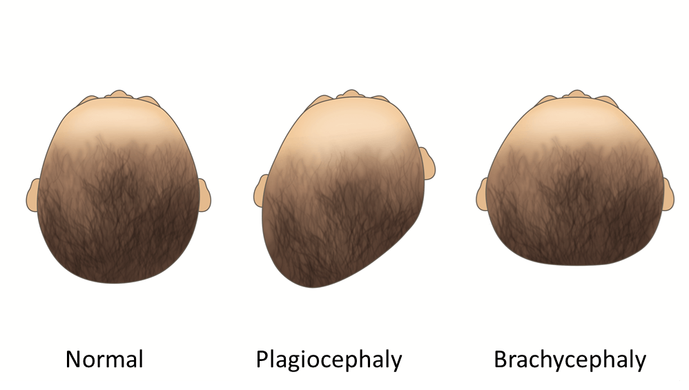 Plagiocephaly